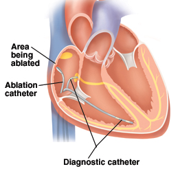 What happens during atrial flutter ablation surgery?